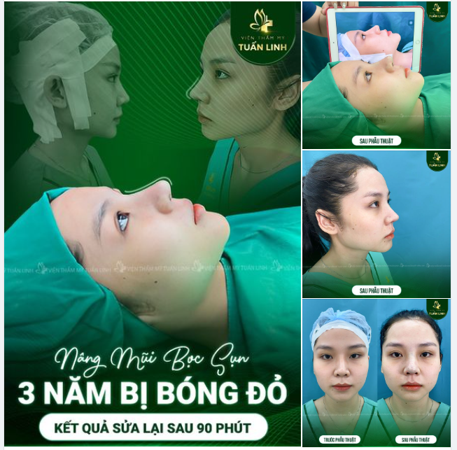 ''Buồn phiền'' Vì nâng mũi không hợp mặt ...Thì phải làm sao?