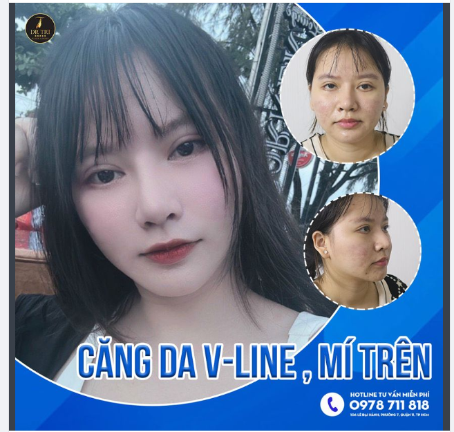 NHÃO MẤY CŨNG GỌN NHỜ CĂNG DA V-LINE!