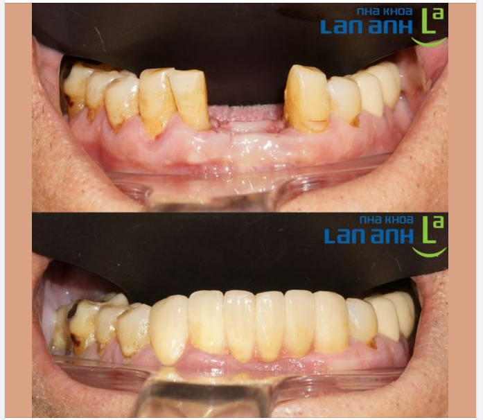 P/s: Một ca làm cầu răng sứ của bác sĩ Dũng, chi nhánh 149 Tôn Dật Tiên, Q.7!
