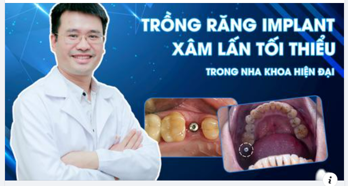 Nhiều người thường băn khoăn cấy Implant đã có từ bao giờ, phương pháp này có thành công tuyệt đối hay không?
