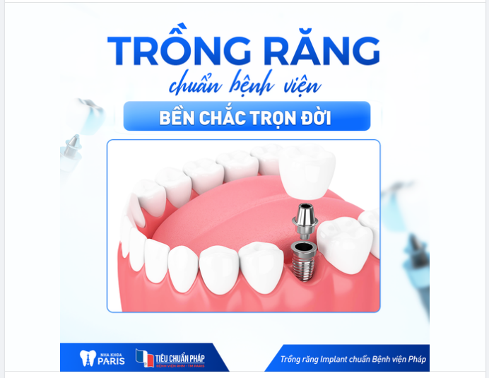 5 Lí Do Trồng Răng Chuẩn Bệnh Viện Pháp Sẽ Cho Bạn Hàm Răng Bền Chắc Trọn Đời!