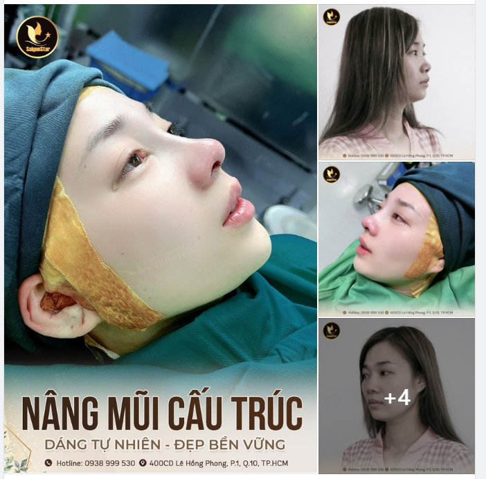 NÂNG MŨI CẤU TRÚC DR. HOẠT: DÁNG TỰ NHIÊN – ĐẸP BỀN VỮNG
