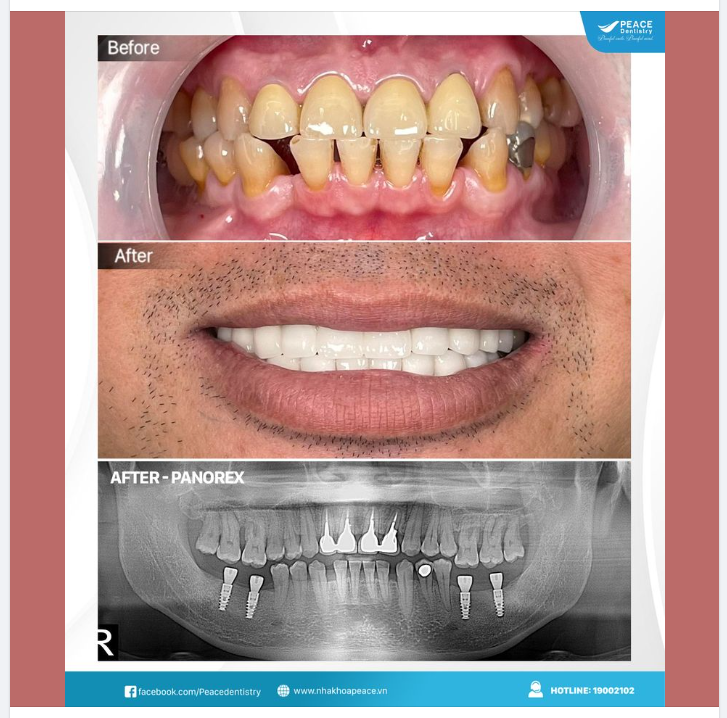 Ca lâm sàng Cấy ghép implant và thẩm mỹ răng sứ khôi phục trọn vẹn, nâng cấp toàn diện cả chức năng ăn nhai và thẩm mỹ nụ cười cho khách hàng.