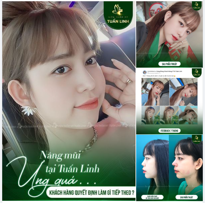 Vì quá ưng dáng mũi nhà Tuấn Linh nên sau khi mũi ổn định bạn ấy đã đưa mẹ mình qua làm mũi luôn đó ạ!!