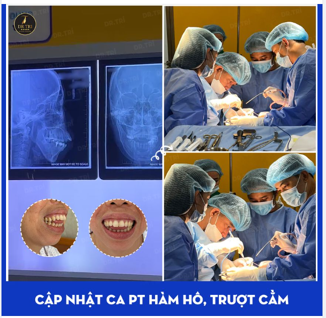 NỖ LỰC TẠO HÌNH LẠI HÀM MẶT CHO BỆNH NHÂN HÔ HÀM TRÊN, THIỂU SẢN XƯƠNG HÀM DƯỚI