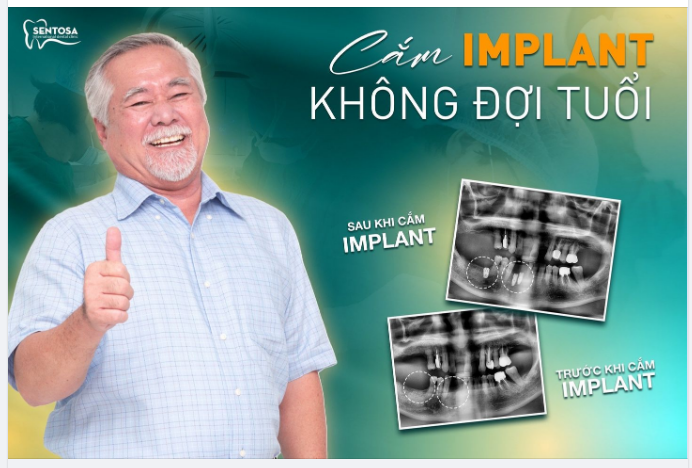 GÓC FEEDBACK CẮM IMPLANT KHÔNG ĐỢI TUỔI
