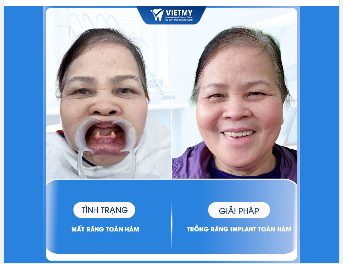 Mất răng giờ đây không còn là vấn đề đáng lo ngại với nhiều người. Thậm chí mất răng toàn hàm đều có khả năng phục hồi lại hoàn chỉnh chức năng ăn nhai cho cô chú
