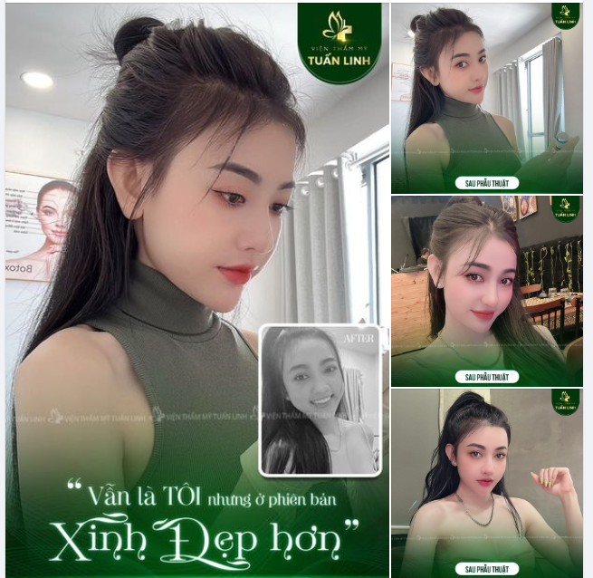 Sở hữu vẻ đẹp toàn diện, tôn lên đường nét thanh tú, xinh sang cho khách hàng với dịch vụ nâng mũi cấu trúc!!