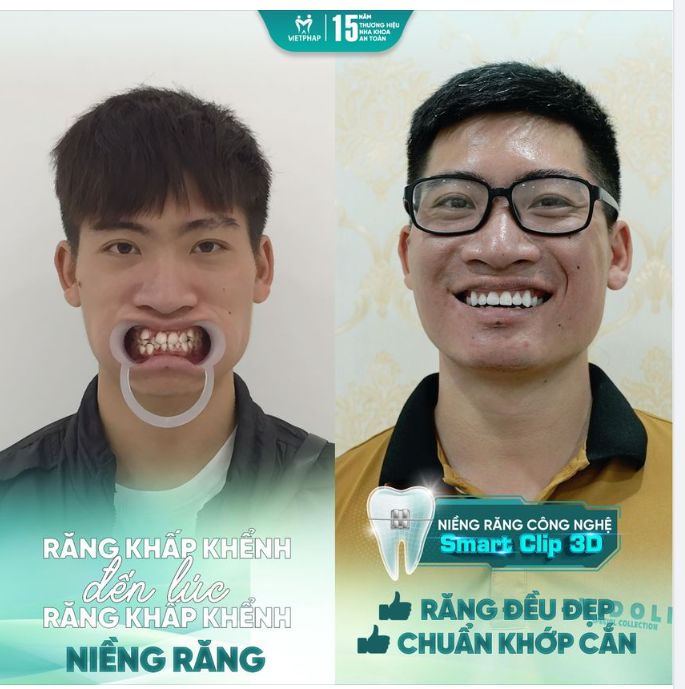 TẠM BIỆT RĂNG HÔ - KHỚP CẮN LỆCH NHỜ NIỀNG RĂNG CÔNG NGHỆ SMART CLIP 3D