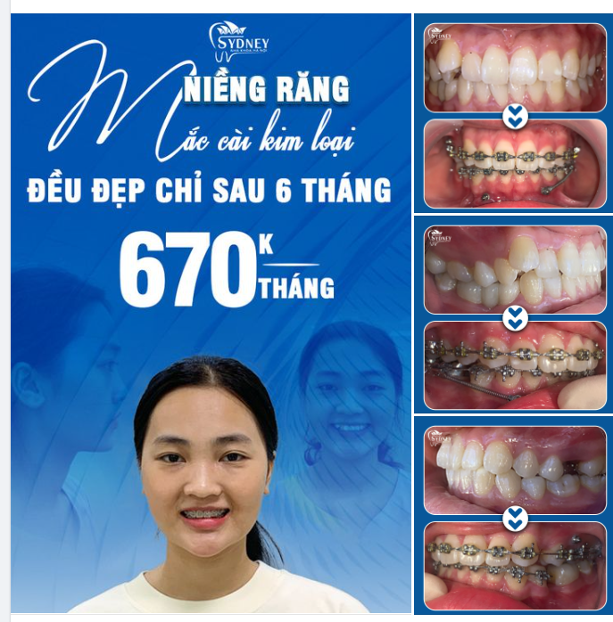 XÓA BỎ KHẤP KHỂNH SAU 6 THÁNG