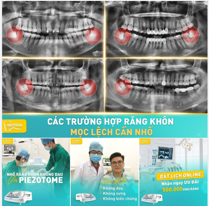 NHỔ RĂNG KHÔN MỌC LỆCH CHỈ TỪ 500.000 VND/RĂNG