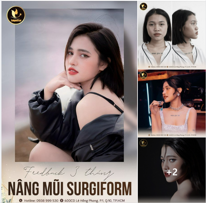 FEEDBACK NÂNG MŨI SURGIFORM SAU 3 THÁNG