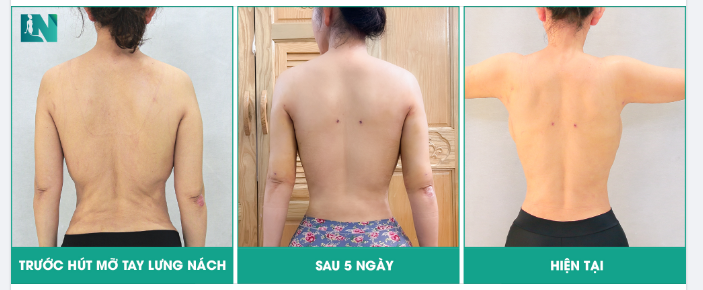 TỰ TIN KHOE LƯNG TRẦN NUỘT NÀ, GỢI CẢM – BÍ QUYẾT CHỈ SAU 90 PHÚT.