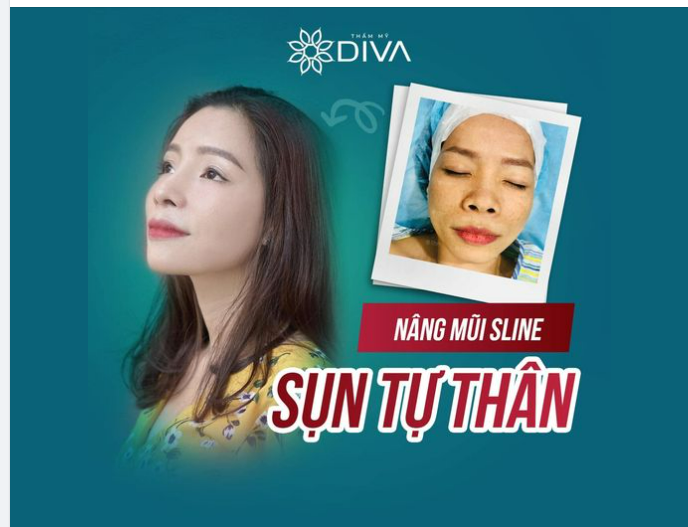 NÂNG MŨI SLINE SỤN TỰ THÂN: NÂNG TẦM NHAN SẮC