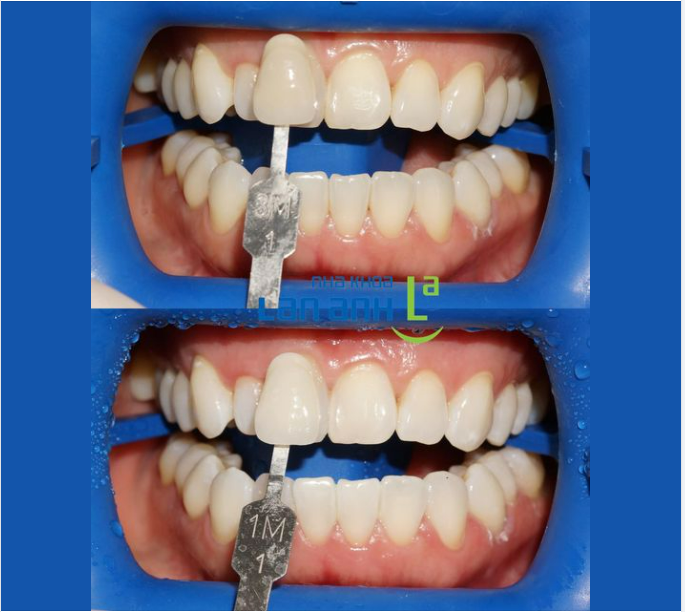 Nếu bạn muốn nhanh chóng sở hữu hàm răng trắng sáng cấp tốc , tẩy trắng răng tại phòng nha là giải pháp bạn nên lựa chọn.
