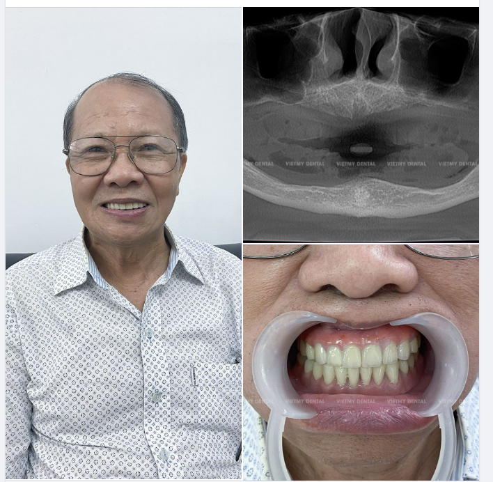 TRỒNG RĂNG IMPLANT TOÀN 2 HÀM : ĂN NGON HƠN - SỐNG KHỎE HƠN