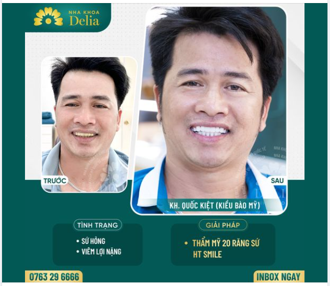 Xử lý răng sứ hỏng - lấy lại nụ cười khỏe đẹp sau 48H!