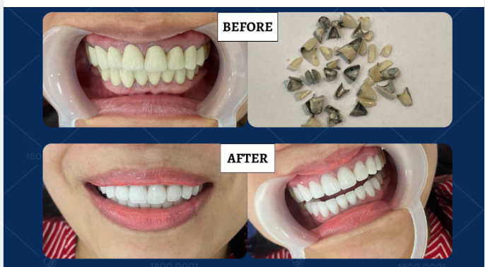 KHÁCH VIỆT KIỀU VỘI VỀ LÀM RĂNG SỨ ĐỂ LẤY LẠI NỤ CƯỜI TỰ TIN