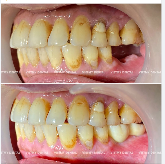 Trồng răng lmplant cho trường hợp mất răng hàm tại Nha Khoa Quốc Tế Việt Mỹ