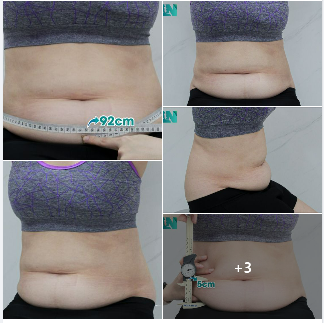 HÚT MỠ TẠO DÁNG THẨM MỸ CHO CHỊ KH 7X TỪNG THỰC HIỆN NHIỀU DỊCH VỤ THẨM MỸ TẠI EKIP BÁC SĨ LƯƠNG NGỌC. TRỰC TIẾP 15H00 HÔM NAY.