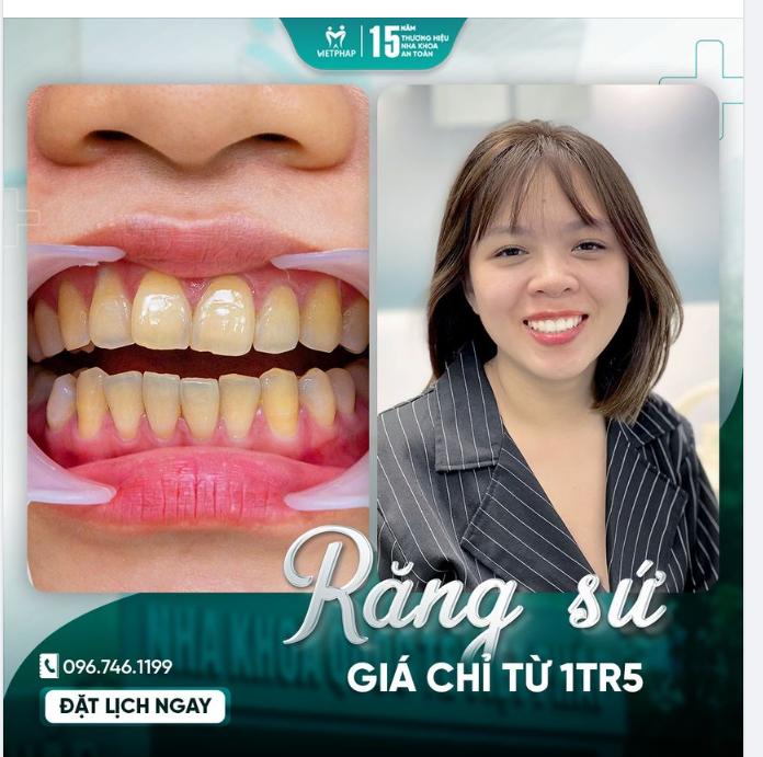 Chia sẻ ca làm răng sứ thành công từ khách hàng Nguyễn Thùy Linh - cơ sở Trần Đăng Ninh