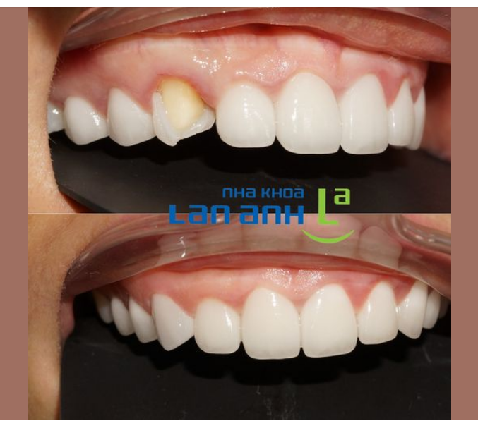 Nhiều người hỏi rằng lỡ làm răng sứ nơi khác mà bị bể, bây giờ ghé nha khoa Lan Anh làm lại thì có giống 100% răng sứ làm ở nơi khác không?