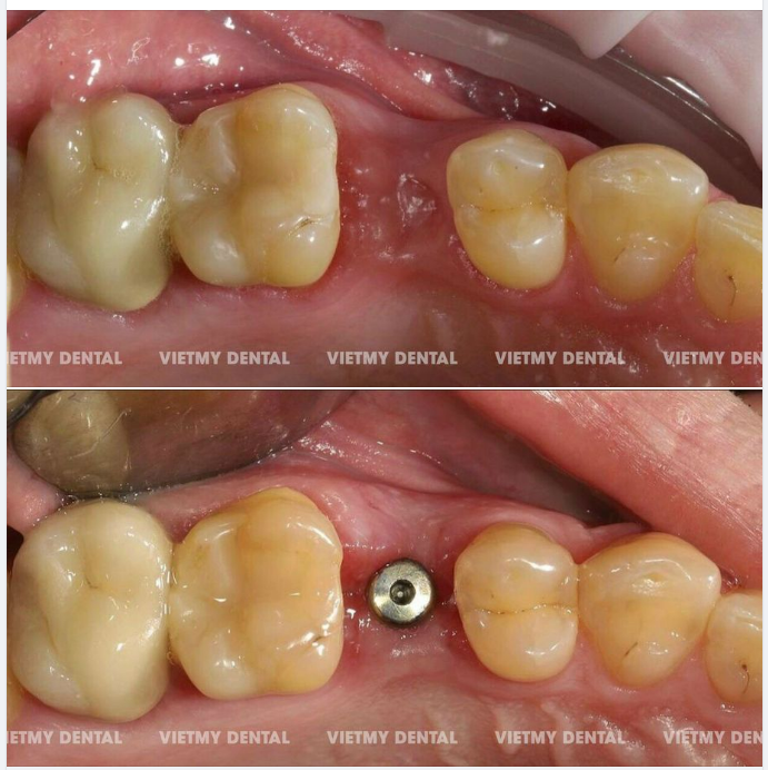 TIẾP TỤC LÀ CASE TRỒNG RĂNG IMPLANT KHÔNG ĐAU TẠI NHA KHOA QUỐC TẾ VIỆT MỸ