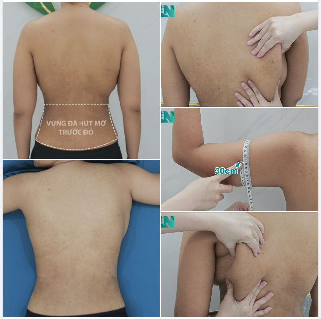 ĐỢT 2: HÚT MỠ TẠO DÁNG THẨM MỸ VÙNG TAY – LƯNG – NÁCH CHO CHỊ KH 35 TUỔI, ĐÃ THỰC HIỆN HÚT MỠ BỤNG TẠI EKIP 1 THÁNG TRƯỚC. TRỰC TIẾP 15H00 HÔM NAY