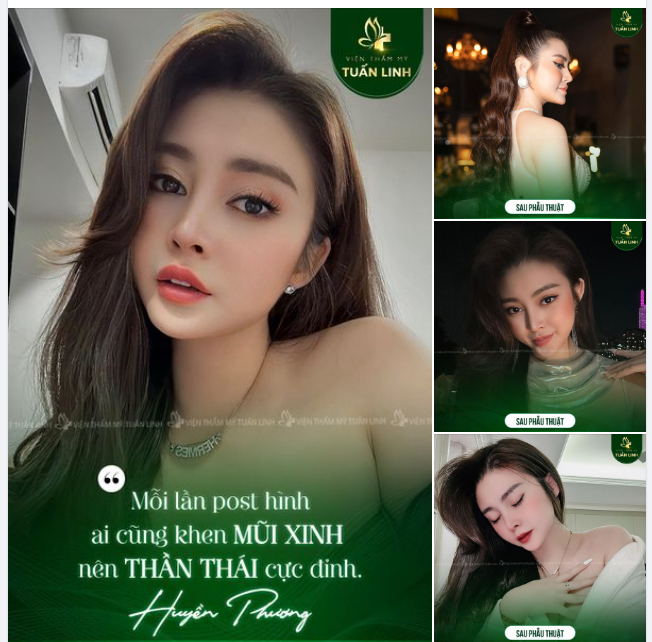 Khách hàng H.P đẹp thần thái với dáng mũi Angel Line cao xinh!
