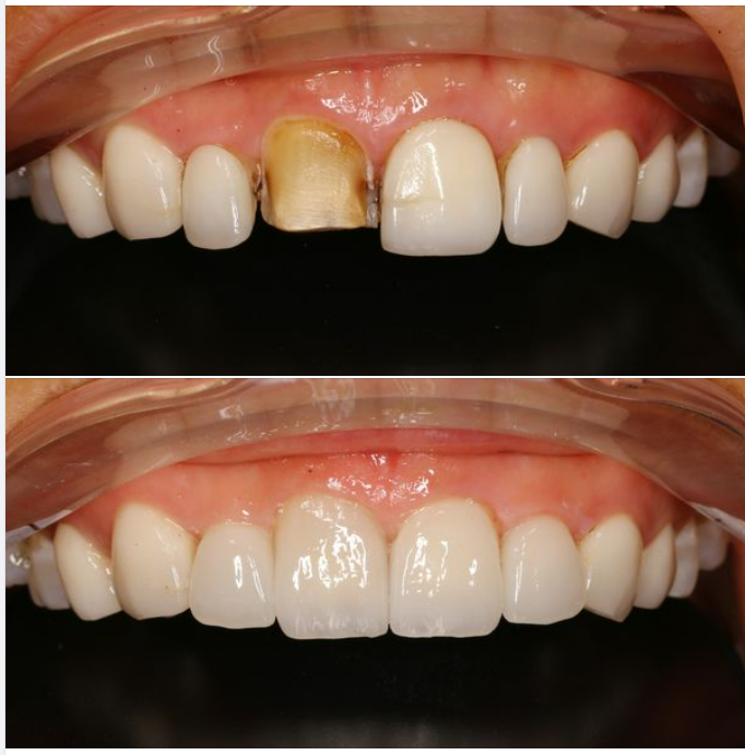 Một ca làm mặt dán Veneer sứ phải làm lại tại nha khoa Lan Anh.