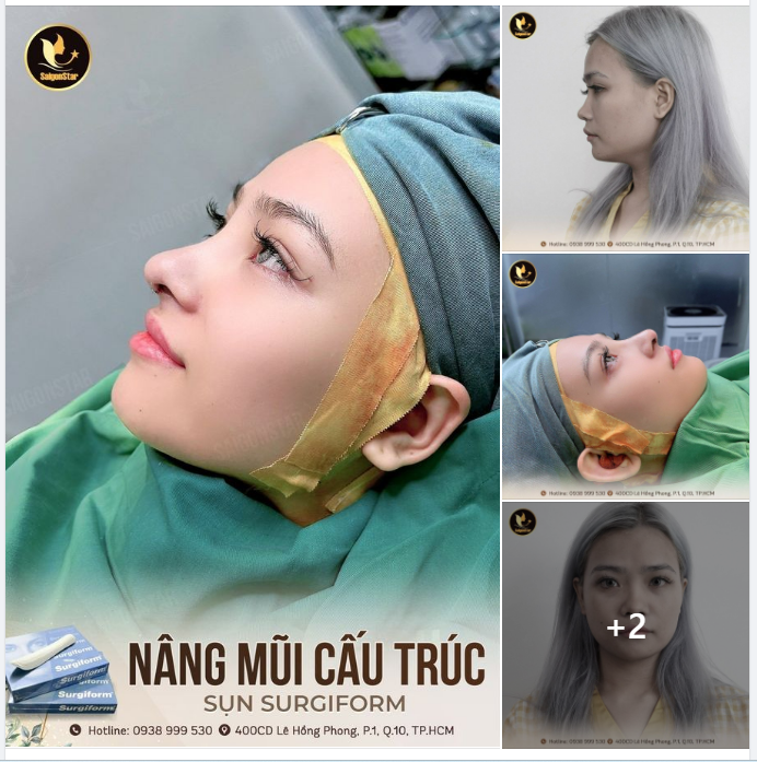 NÂNG MŨI CẤU TRÚC SỤN SURGIFORM