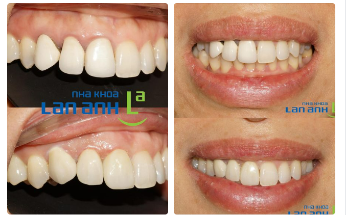 Tác hại của răng sứ Kim loại:
