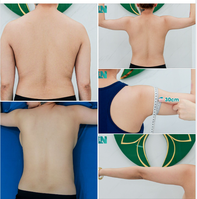  HÚT MỠ TẠO DÁNG THẨM MỸ VÙNG TAY, LƯNG, NÁCH CHO CHỊ KH ĐƯỢC BẠN GIỚI THIỆU GIẢI PHÁP GIẢM MỠ AN TOÀN. 