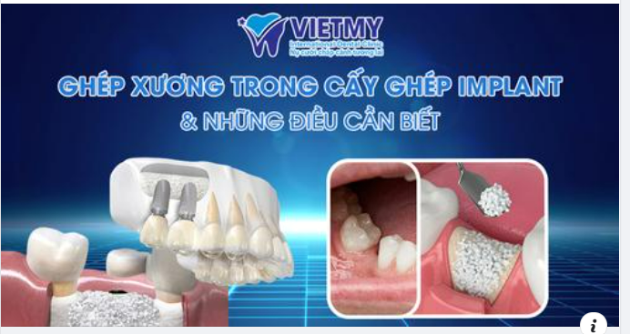 Một trong những câu hỏi được quan tâm nhất chính là GHÉP XƯƠNG trong CẤY GHÉP IMPLANT