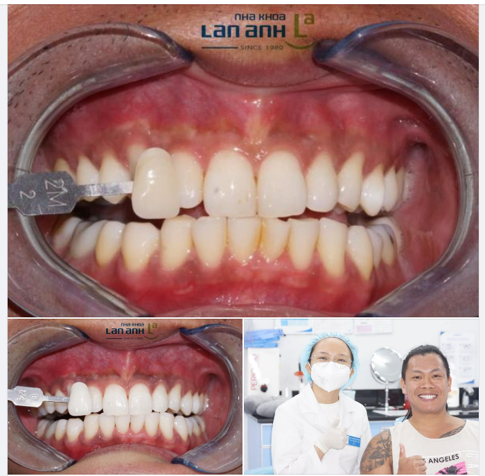 TẨY TRẮNG TẠI PHÒNG, RĂNG SÁNG BẬT TÔNG.