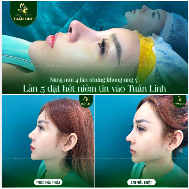 SỰ KHÁC BIỆT NẰM Ở PHẦN ĐẦU MŨI, CHÓP MŨI...!!