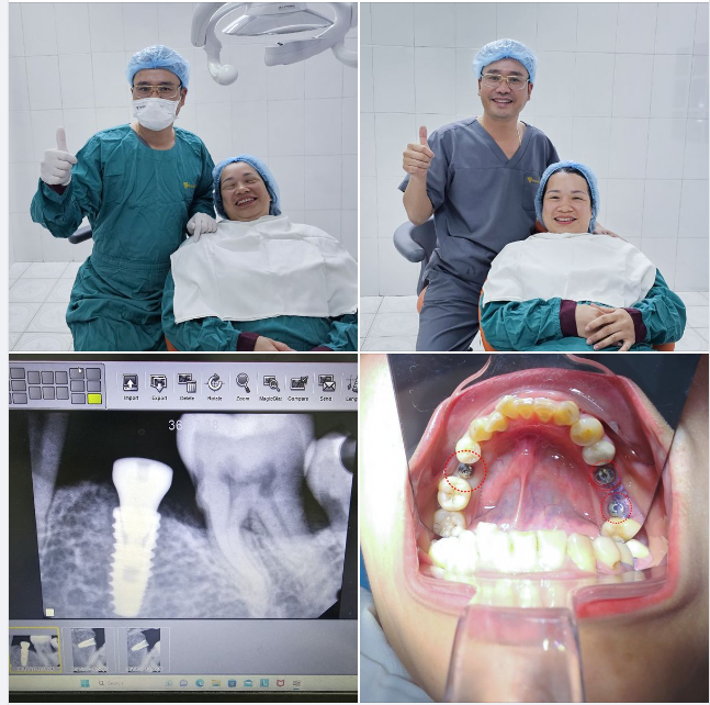HÀNH TRÌNH TRỒNG RĂNG IMPLANT- HÀNH TRÌNH TÌM LẠI NỤ CƯỜI ĐÃ MẤT !