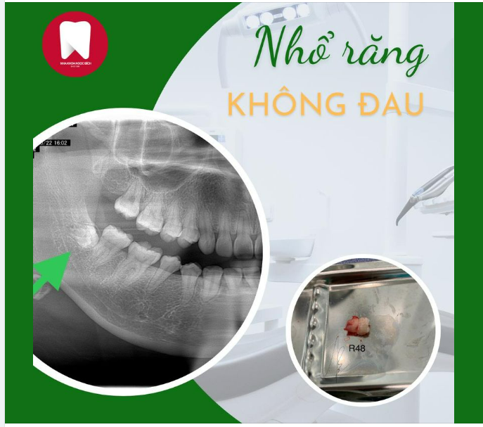 Một ca nhổ khó nhưng không hề làm khó các bác sĩ tại Nha Khoa Ngọc Bích