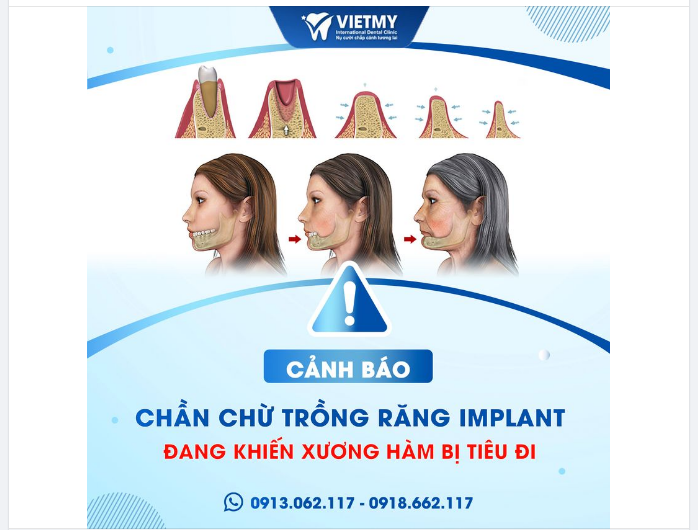 Điều gì sẽ xảy ra khi chúng ta bị mất răng nhưng chần chừ chưa trồng lại ???