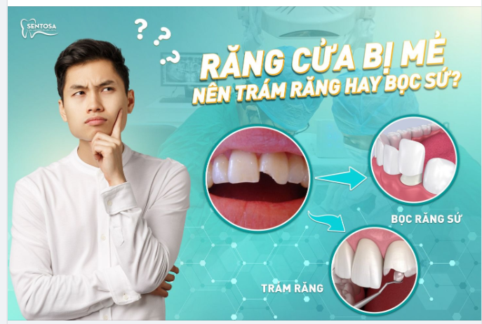 RĂNG CỬA BỊ MẺ NÊN TRÁM RĂNG HAY BỌC SỨ?