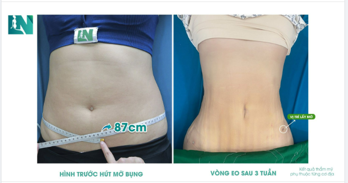 KHÔNG CÒN NHẬN RA MÌNH SAU 3 TUẦN HÚT MỠ TẠO DÁNG THẨM MỸ