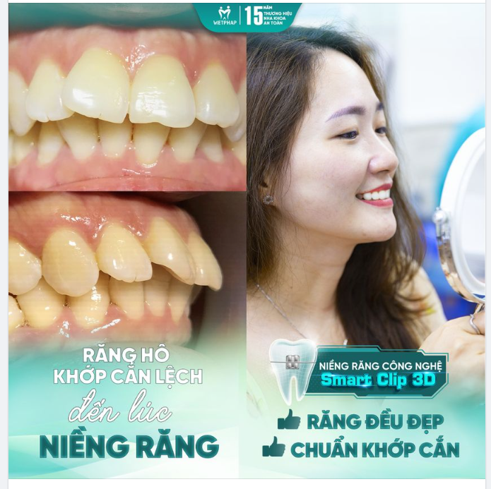 Gen Z tự tin khoe răng xinh, răng đẹp sau niềng răng