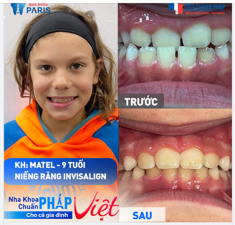 Người Mỹ chọn nha khoa Paris chuẩn Pháp niềng răng trong suốt cho con