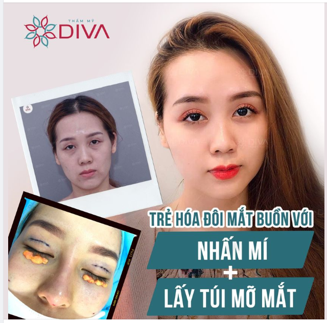 TRẺ HÓA ĐÔI MẮT BUỒN VỚI NHẤN MÍ + LẤY TÚI MỠ MÍ DƯỚI