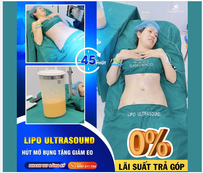 ĐỂ HÚT MỠ KHÔNG ĐÁNG LO, BẠN NÊN CHÚ Ý NHỮNG ĐIỀU SAU!