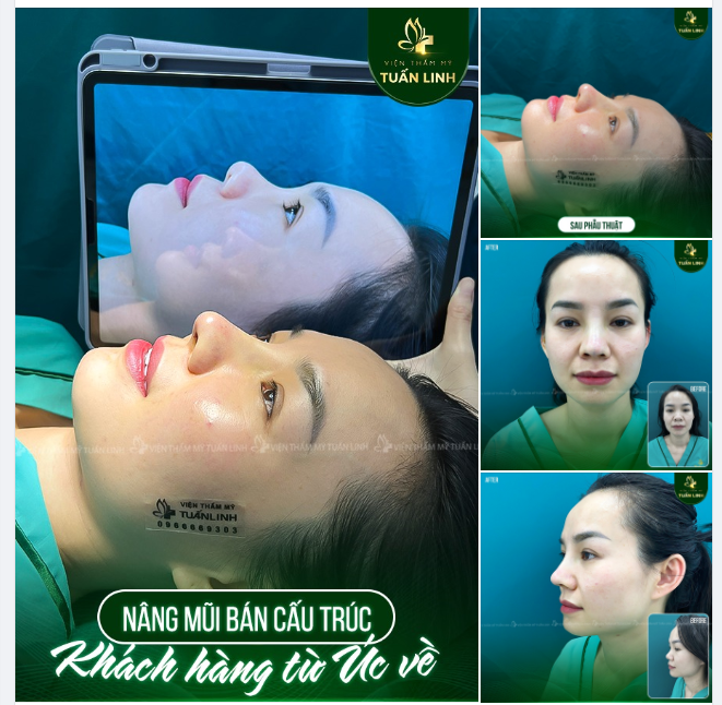 Nhiều bạn thắc mắc '' Nâng mũi có bị sao không?