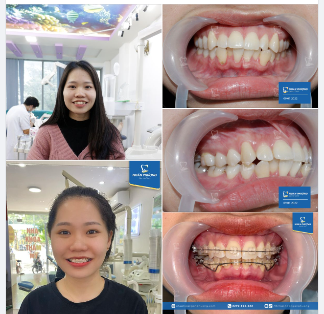 Tình trạng hô có thể do rất nhiều nguyên nhân đến từ răng, xương hàm hoặc cấu trúc khuôn mặt.