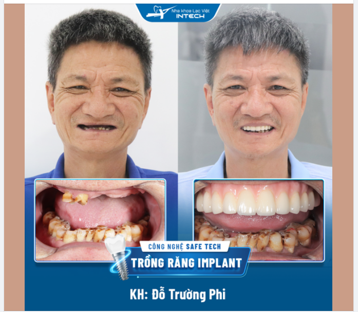 HẾT MÓM - HẾT HÓP MÁ NHỜ TRỒNG RĂNG IMPLANT TOÀN HÀM