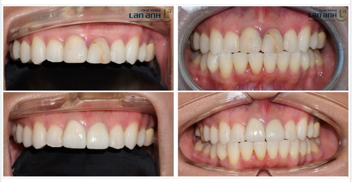 PHỤC HÌNH TOÀN SỨ CHO RĂNG CỬA.