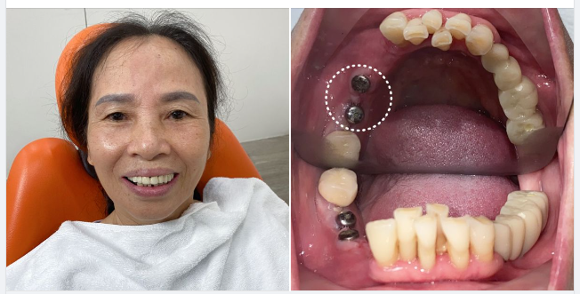 RĂNG KHOẺ ĐẸP, SỐNG LẠC QUAN NHỜ TRỒNG RĂNG IMPLANT CÔNG NGHỆ XÂM LẤN TỐI THIỂU !
